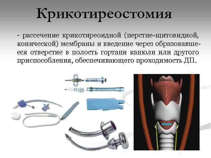 Крикотиреостомия - рассечение крикотиреоидной (перстне-щитовидной, конической) мембраны и введение через образовавшееся отверстие в полость