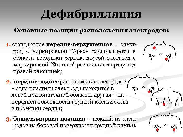 Дефибрилляция Основные позиции расположения электродов: 1. стандартное передне-верхушечное – электрод с маркировкой 