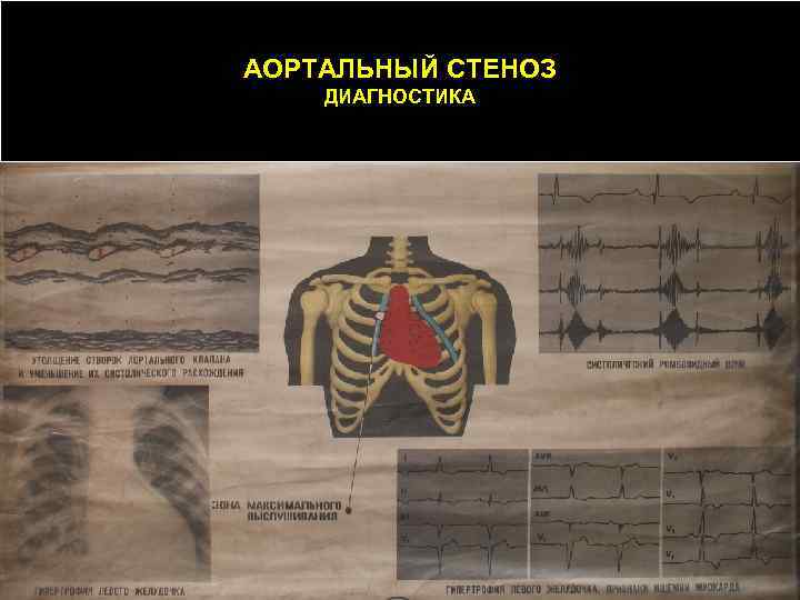 АОРТАЛЬНЫЙ СТЕНОЗ ДИАГНОСТИКА 