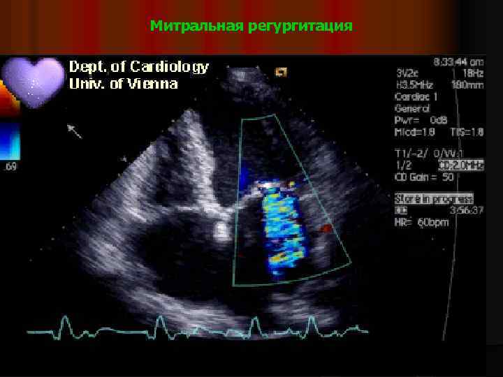 Митральная регургитация 