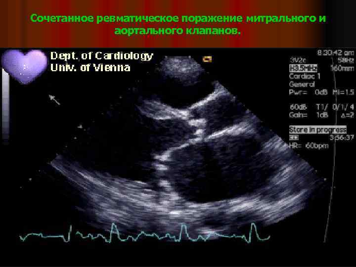 Сочетанное ревматическое поражение митрального и аортального клапанов. 