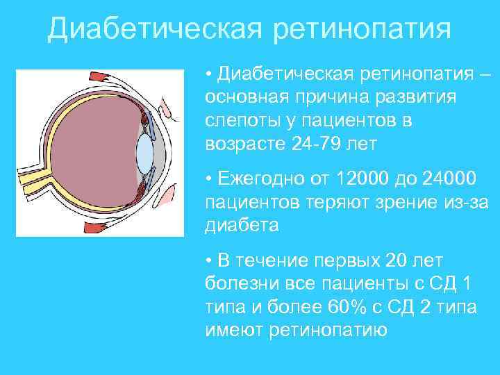 Диабетическая ретинопатия • Диабетическая ретинопатия – основная причина развития слепоты у пациентов в возрасте