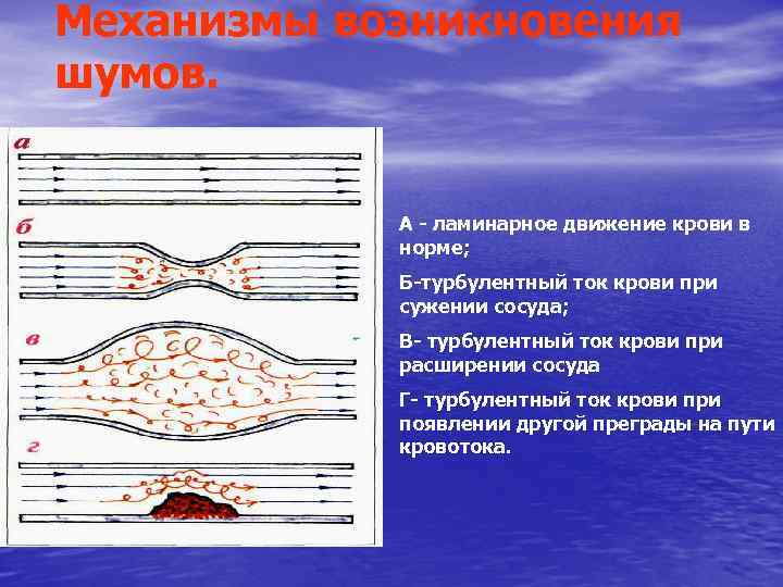 Механизмы возникновения шумов. А ламинарное движение крови в норме; Б турбулентный ток крови при