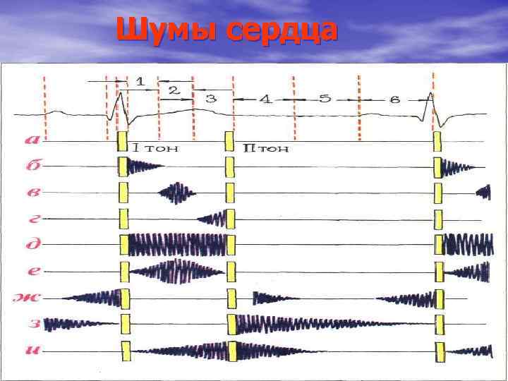 Шумы сердца . 