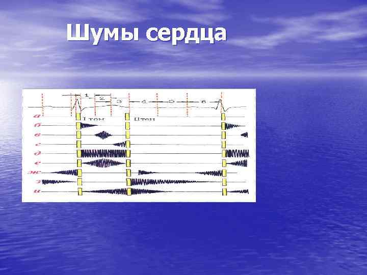 Шумы сердца . 