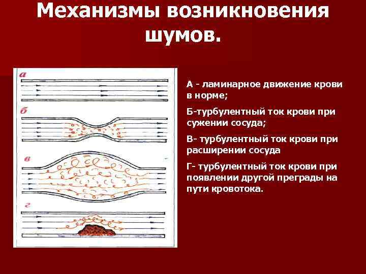 Механизмы возникновения шумов. А - ламинарное движение крови в норме; Б-турбулентный ток крови при