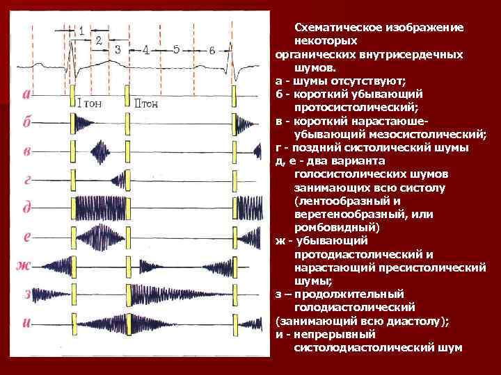 Схематическое изображение некоторых органических внутрисердечных шумов. а - шумы отсутствуют; б - короткий убывающий