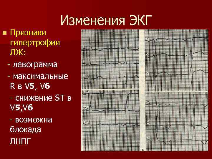 Изменения ЭКГ Признаки гипертрофии ЛЖ: - левограмма - максимальные R в V 5, V