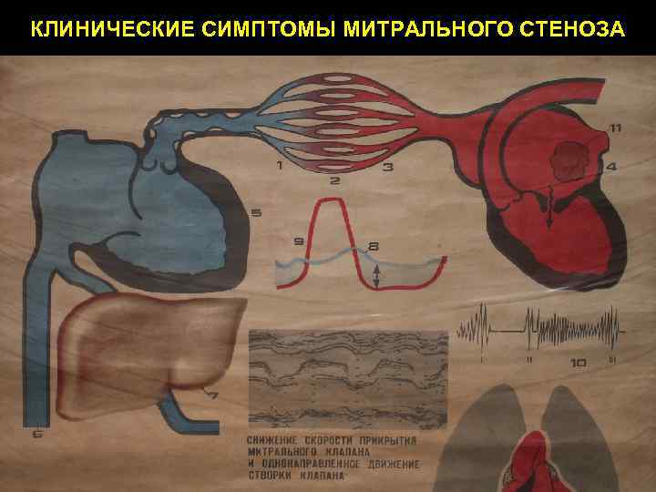 КЛИНИЧЕСКИЕ СИМПТОМЫ МИТРАЛЬНОГО СТЕНОЗА 