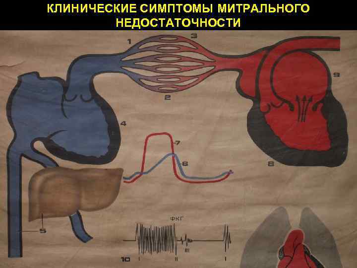 КЛИНИЧЕСКИЕ СИМПТОМЫ МИТРАЛЬНОГО НЕДОСТАТОЧНОСТИ 