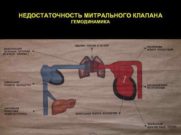 НЕДОСТАТОЧНОСТЬ МИТРАЛЬНОГО КЛАПАНА ГЕМОДИНАМИКА 