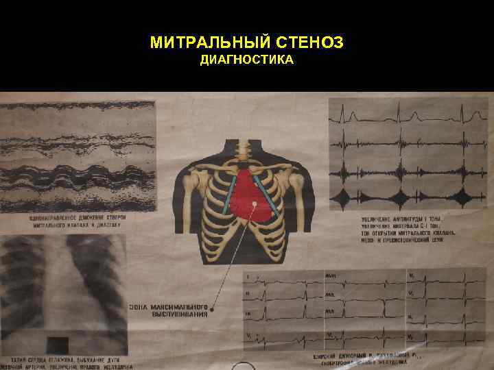 МИТРАЛЬНЫЙ СТЕНОЗ ДИАГНОСТИКА 