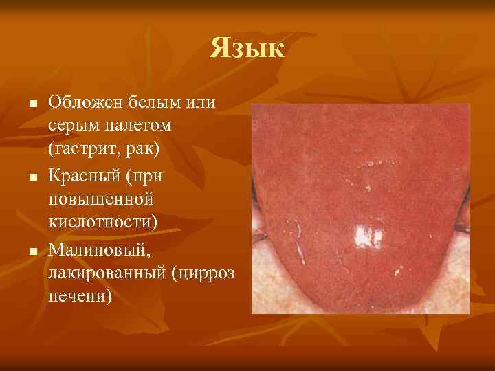 Язык n n n Обложен белым или серым налетом (гастрит, рак) Красный (при повышенной
