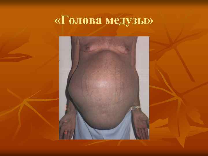  «Голова медузы» 