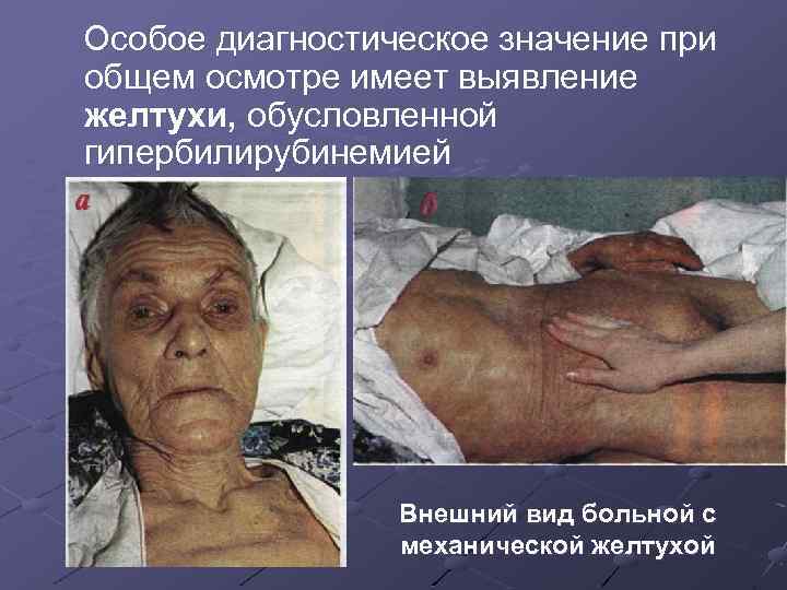 Особое диагностическое значение при общем осмотре имеет выявление желтухи, обусловленной гипербилирубинемией Внешний вид больной