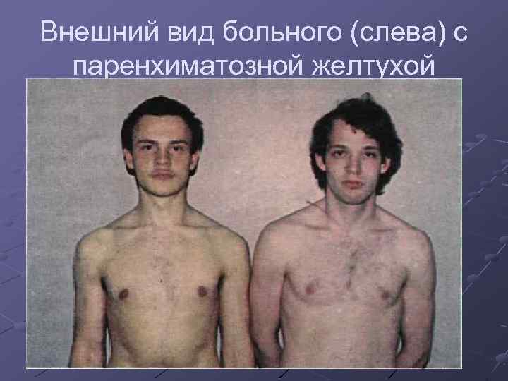 Внешний вид больного (слева) с паренхиматозной желтухой 