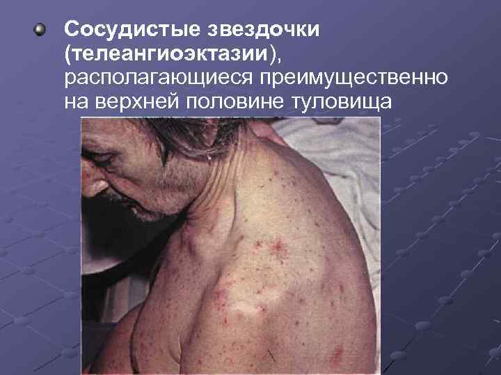 Сосудистые звездочки (телеангиоэктазии), располагающиеся преимущественно на верхней половине туловища 