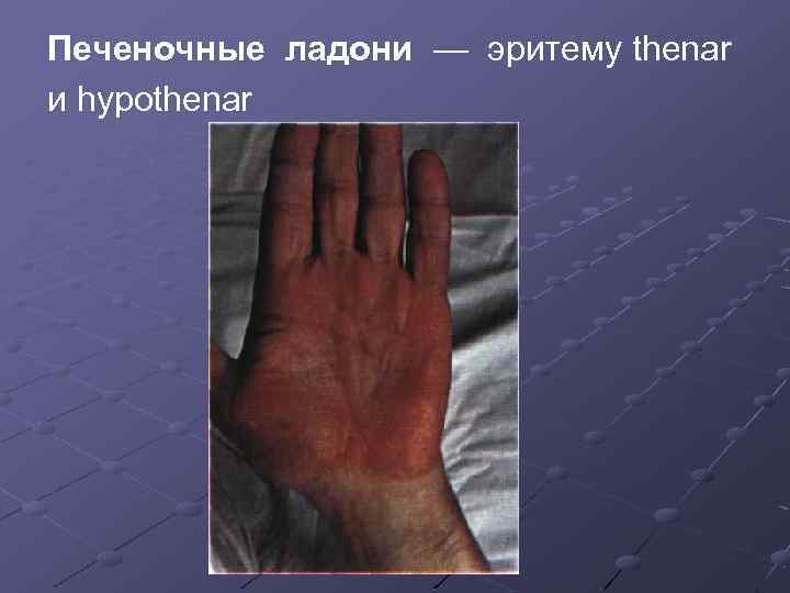 Печеночные ладони — эритему thenar и hypothenar 