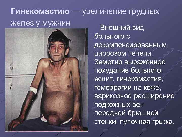 Гинекомастию — увеличение грудных желез у мужчин Внешний вид больного с декомпенсированным циррозом печени.