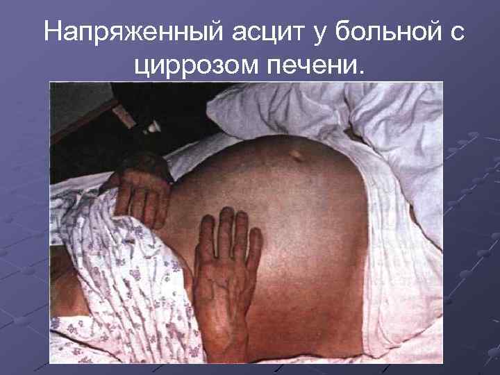 Напряженный асцит у больной с циррозом печени. 