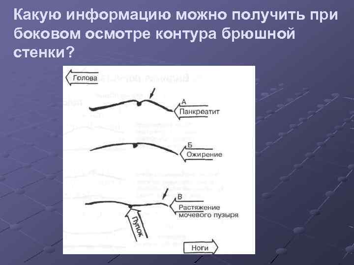Какую информацию можно получить при боковом осмотре контура брюшной стенки? 