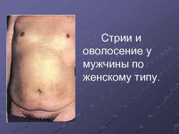 Стрии и оволосение у мужчины по женскому типу. 