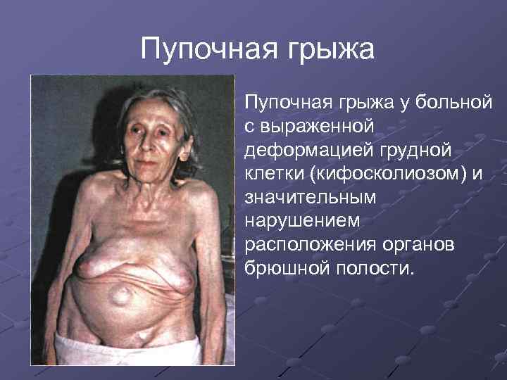 Пупочная грыжа у больной с выраженной деформацией грудной клетки (кифосколиозом) и значительным нарушением расположения