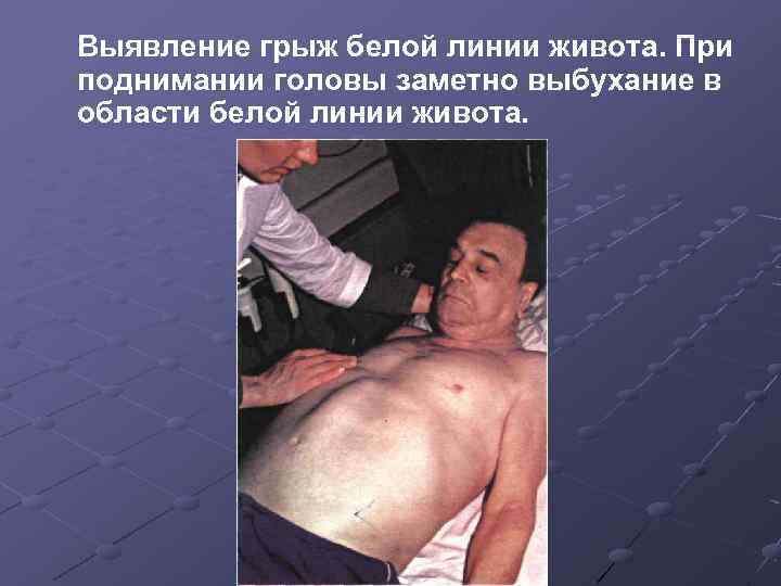 Выявление грыж белой линии живота. При поднимании головы заметно выбухание в области белой линии