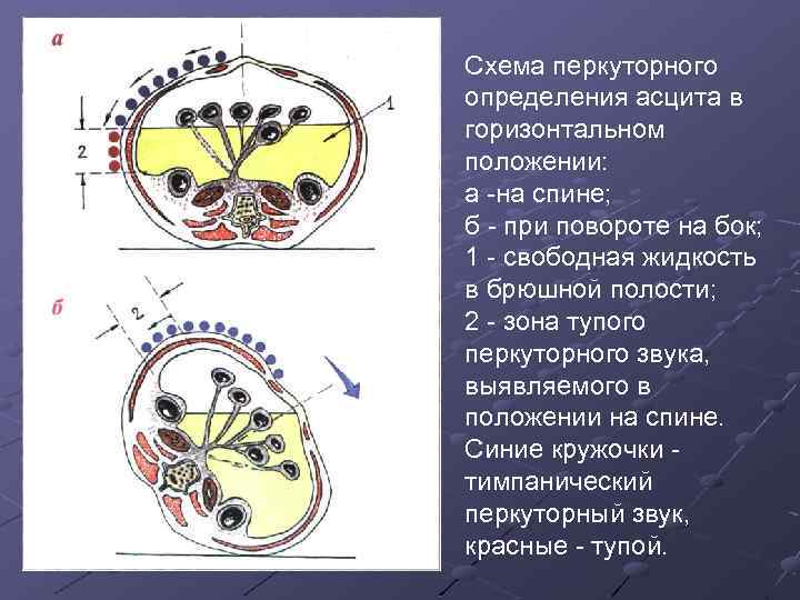Схема перкуторного определения асцита в горизонтальном положении: а на спине; б при повороте на