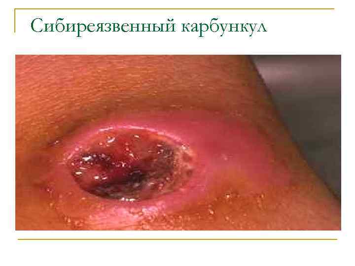Сибиреязвенный карбункул 