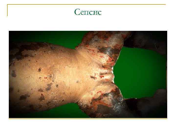 Сепсис 