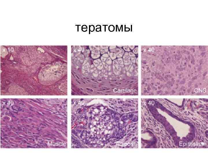 тератомы 