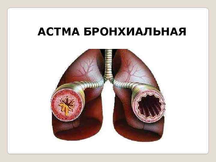 АСТМА БРОНХИАЛЬНАЯ 