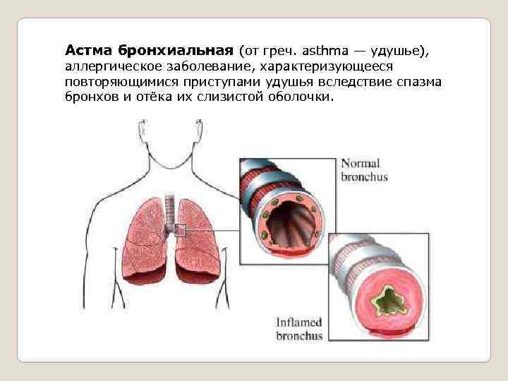 Астма бронхиальная (от греч. asthma — удушье), аллергическое заболевание, характеризующееся повторяющимися приступами удушья вследствие