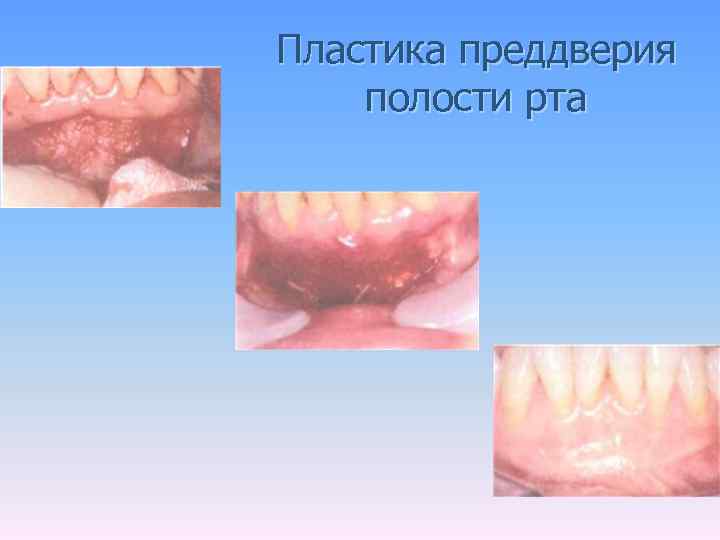 Пластика преддверия полости рта 