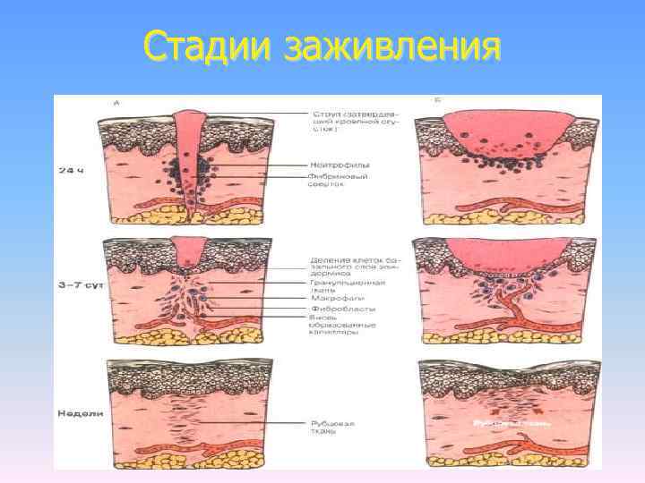 Стадии заживления 