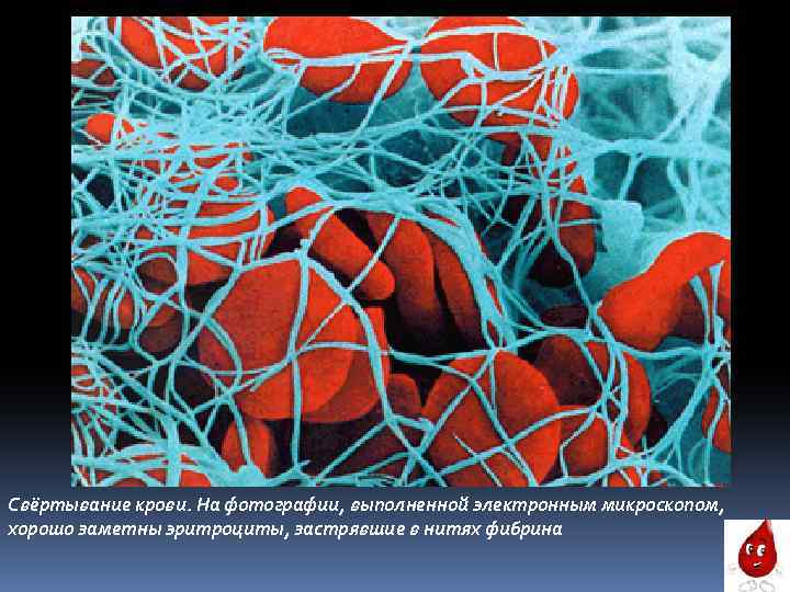 Свёртывание крови. На фотографии, выполненной электронным микроскопом, хорошо заметны эритроциты, застрявшие в нитях фибрина