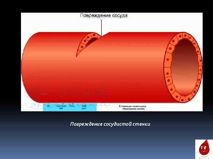 Повреждение сосудистой стенки 