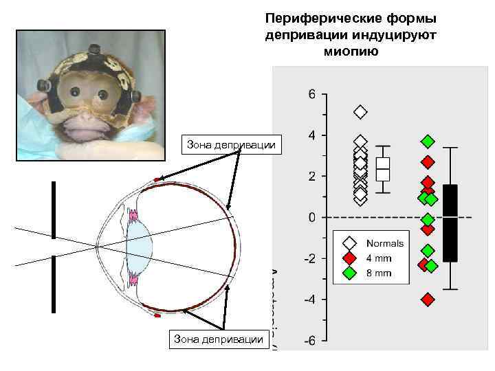 Периферические формы депривации индуцируют миопию Зона депривации 