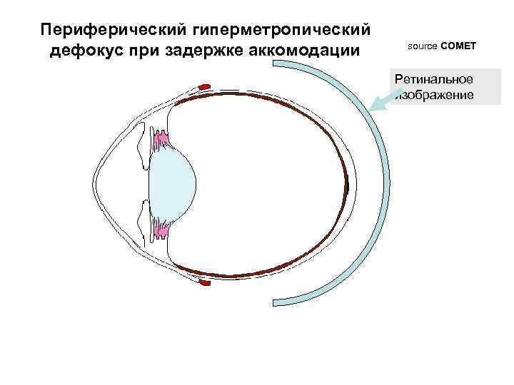 Периферический гиперметропический дефокус при задержке аккомодации source COMET Ретинальное изображение 