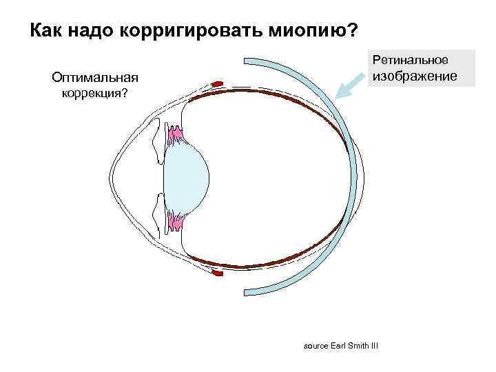 Как надо корригировать миопию? Ретинальное Оптимальная изображение коррекция? source Earl Smith III 