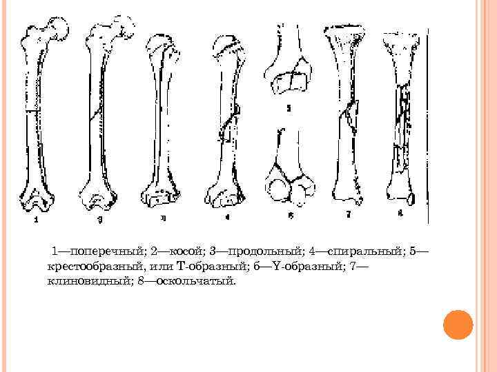 1—поперечный; 2—косой; 3—продольный; 4—спиральный; 5— крестообразный, или Т-образный; б—Y-образный; 7— клиновидный; 8—оскольчатый. 