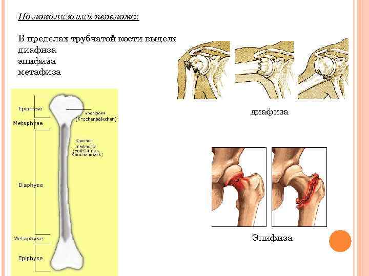 По локализации перелома: В пределах трубчатой кости выделяют диафиза эпифиза метафиза диафиза Эпифиза 