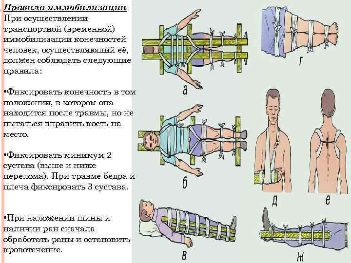 Правила иммобилизации При осуществлении транспортной (временной) иммобилизации конечностей человек, осуществляющий её, должен соблюдать следующие