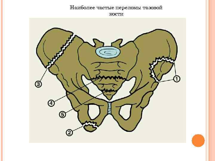 Наиболее частые переломы тазовой кости 