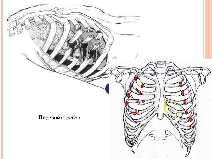 Полом ребра