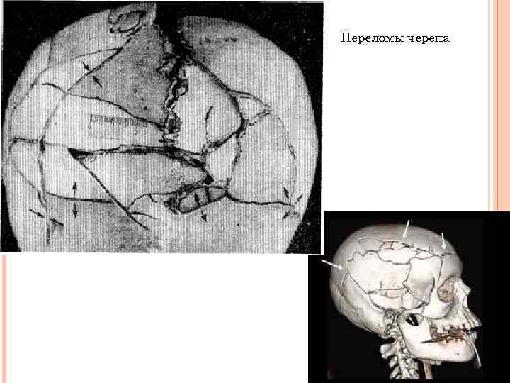 Переломы черепа 