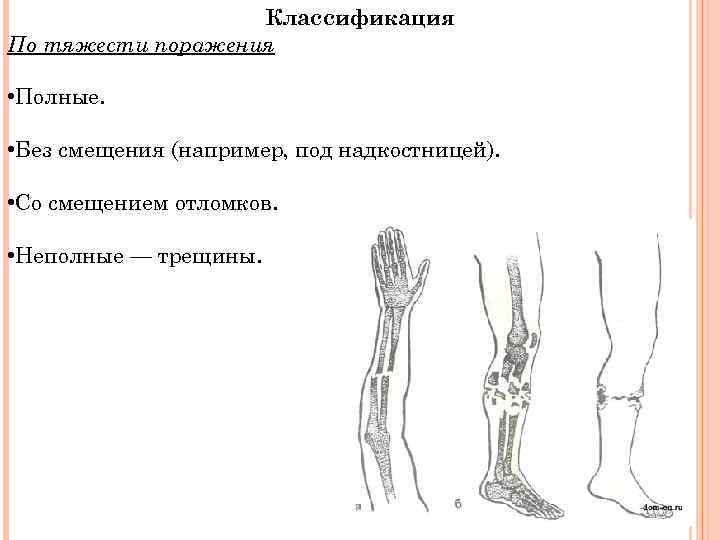 Классификация По тяжести поражения • Полные. • Без смещения (например, под надкостницей). • Со