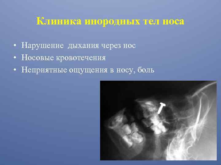 Клиника инородных тел носа • Нарушение дыхания через нос • Носовые кровотечения • Неприятные