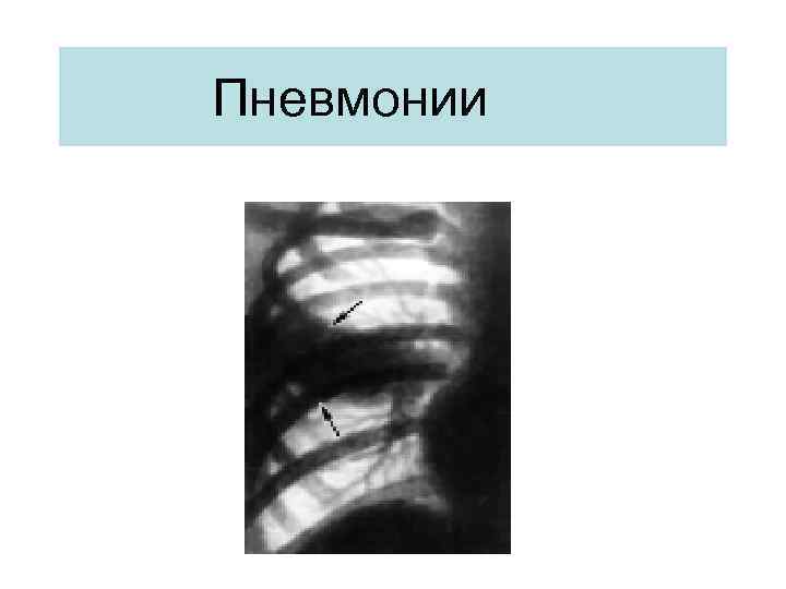 Пневмонии 